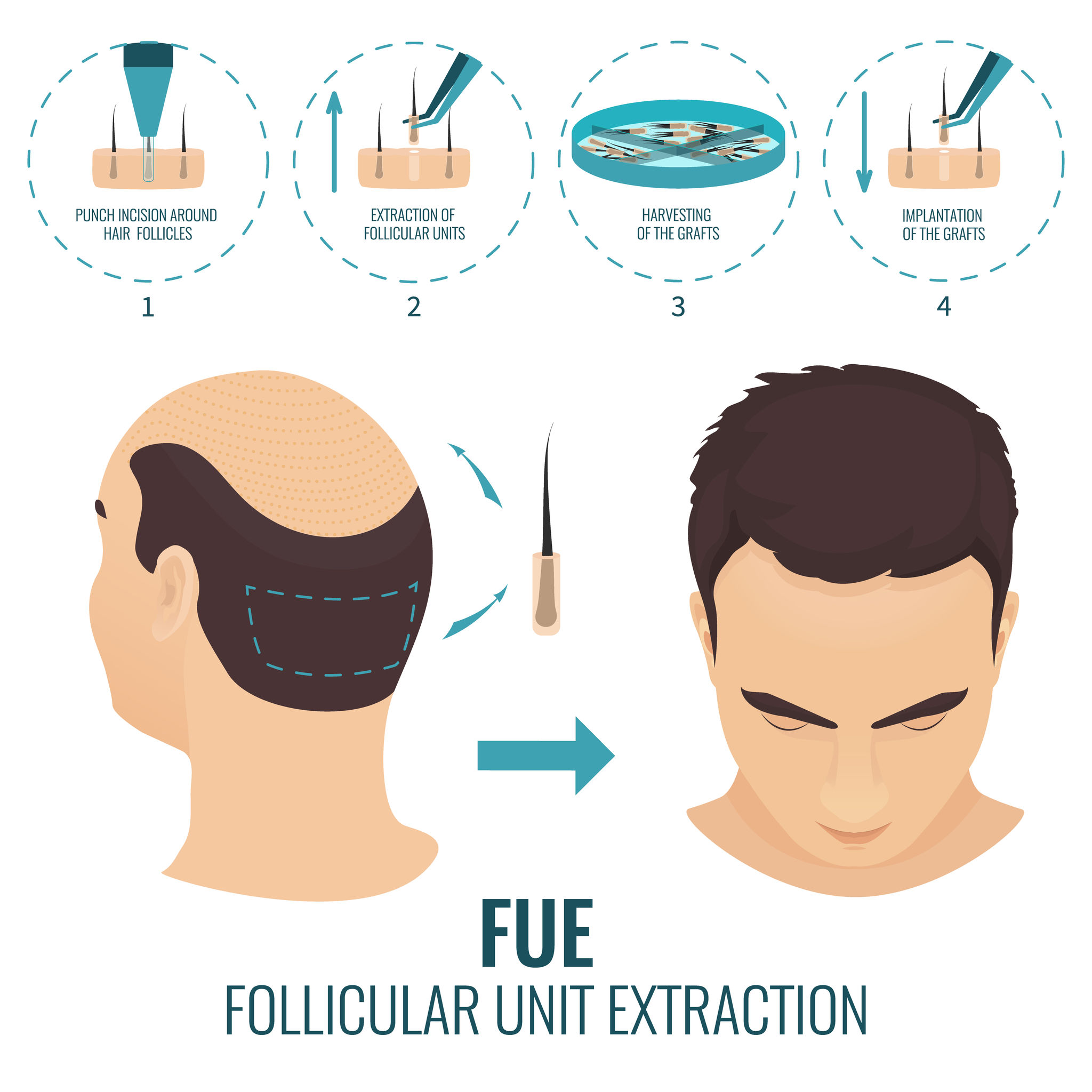 Facial hair restoration