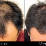 Men's Hair Restoration with NeoGraft in Buckhead Atlanta