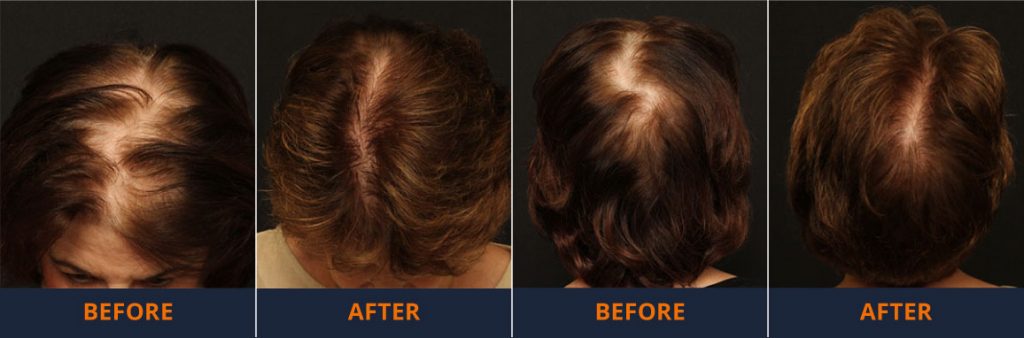 Before & After Neograft Treatment -Female Hair Loss Treatments 