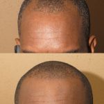 African American Hair Restoration with NeoGraft in Buckhead Atlanta