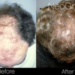 Atlanta Male Hair Restoration with NeoGraft