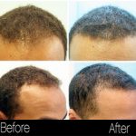 Buckhead African American Male Hair Restoration with NeoGraft