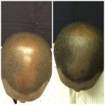 African American Hair Restoration