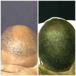 2200 Grafts NEOGRAFT Patient before and 5 days Post Operative