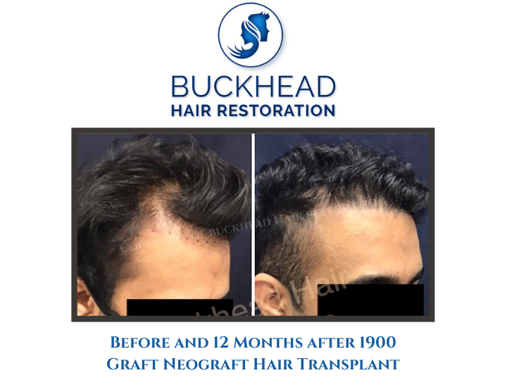 Before and 12 Months after 1900 Graft Neograft Hair Transplant