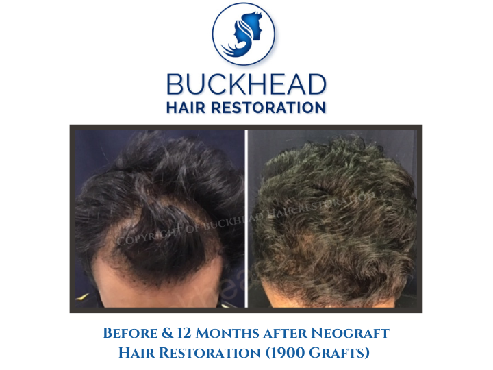 Before and after Hair Transplant by Dr. Monte S