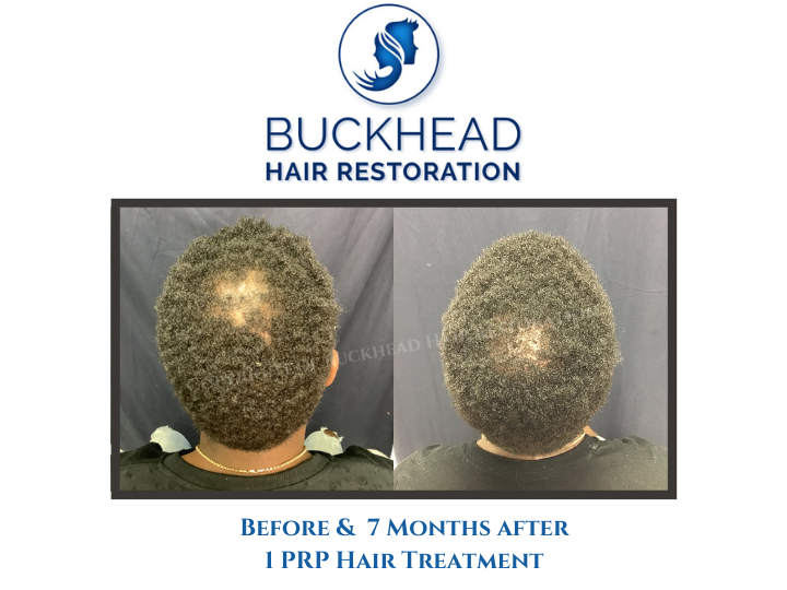 Top View - Before and after 7-months of receiving PRP Hair Therapy