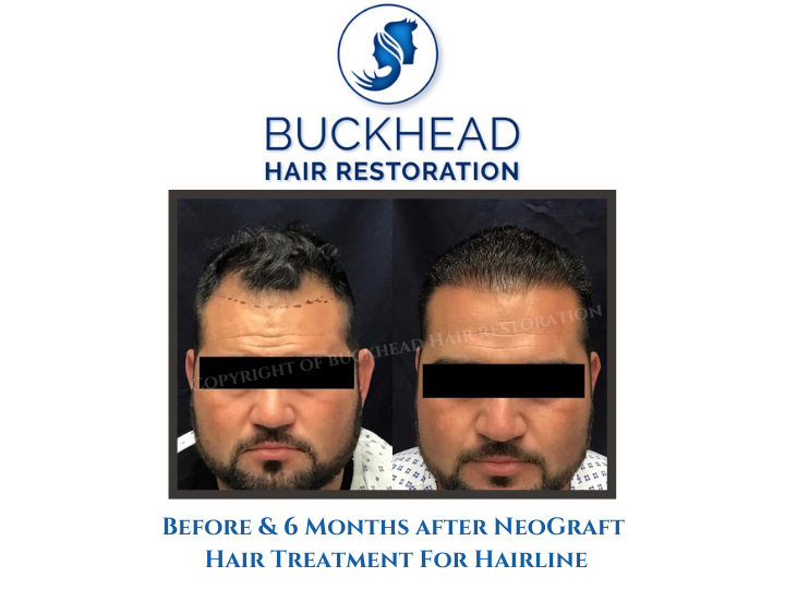 before-6-months-after-neograft-hair-treatment-for-hairline
