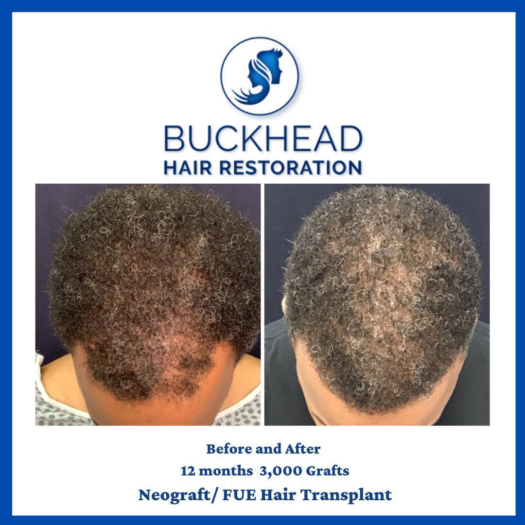 Before and After 12 Months 3,000 Grafts Neograft / FUE Hair Transplant