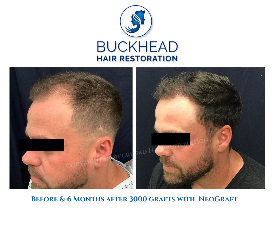 Before and after Neograft 3000 grafts at Buckhead Hair Restoration