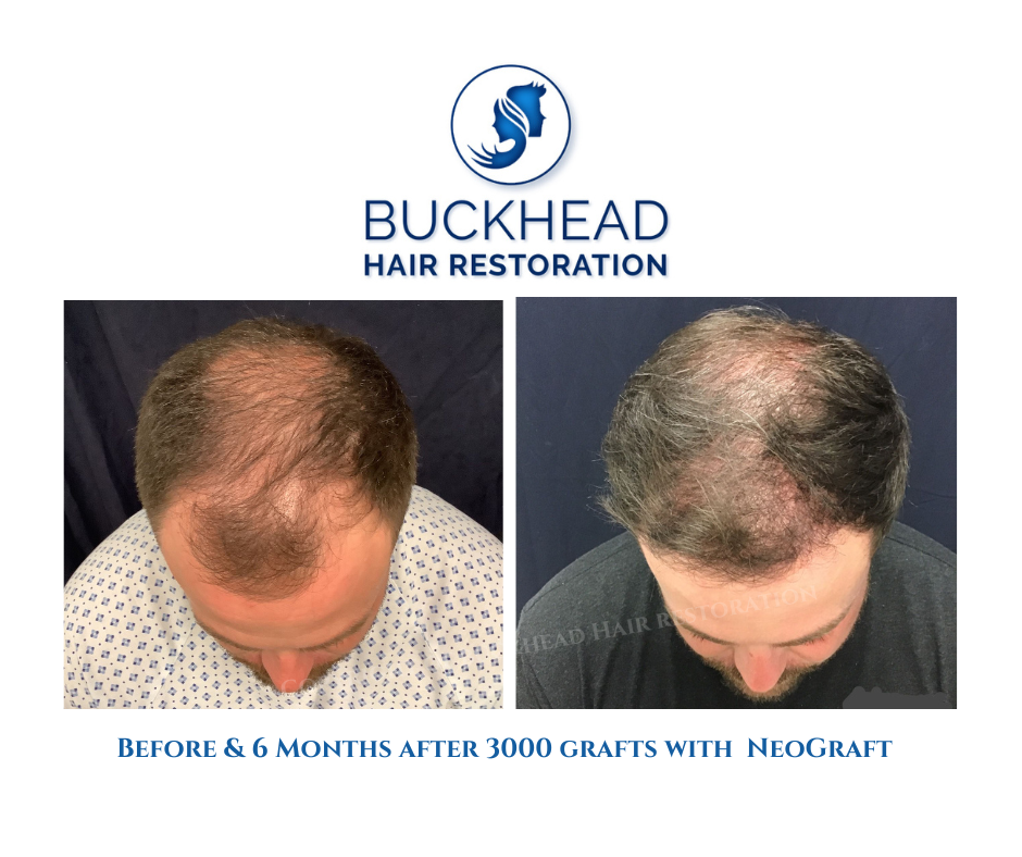 Before and after 3000 grafts