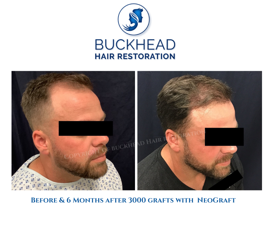 Before and after Neograft 3000 grafts