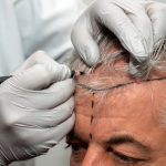 Top Hair Restoration Treatments That Actually Work
