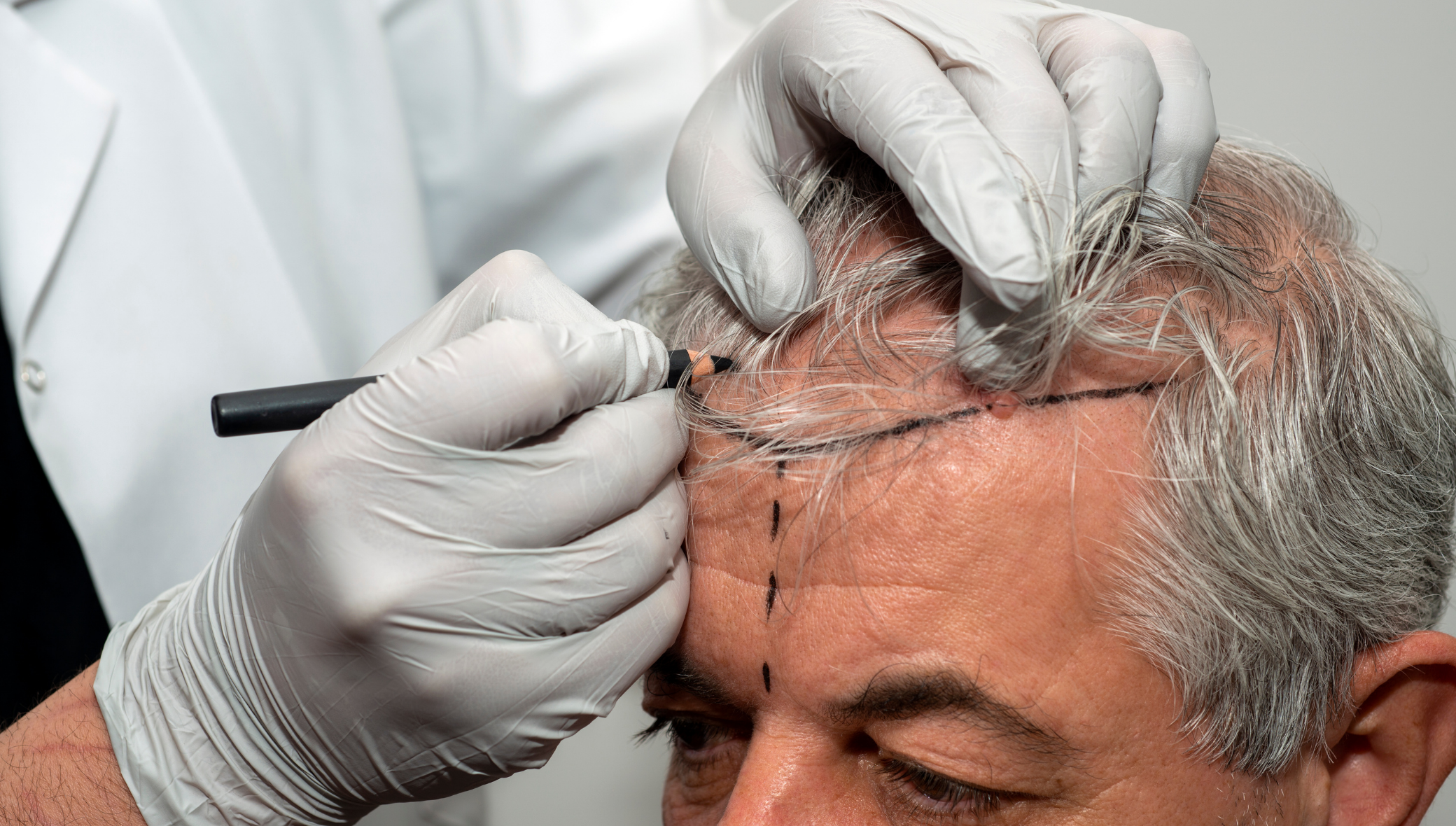 Top Hair Restoration Treatments That Actually Work
