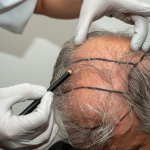 What to Expect During Your First Hair Restoration Consultation in Atlanta