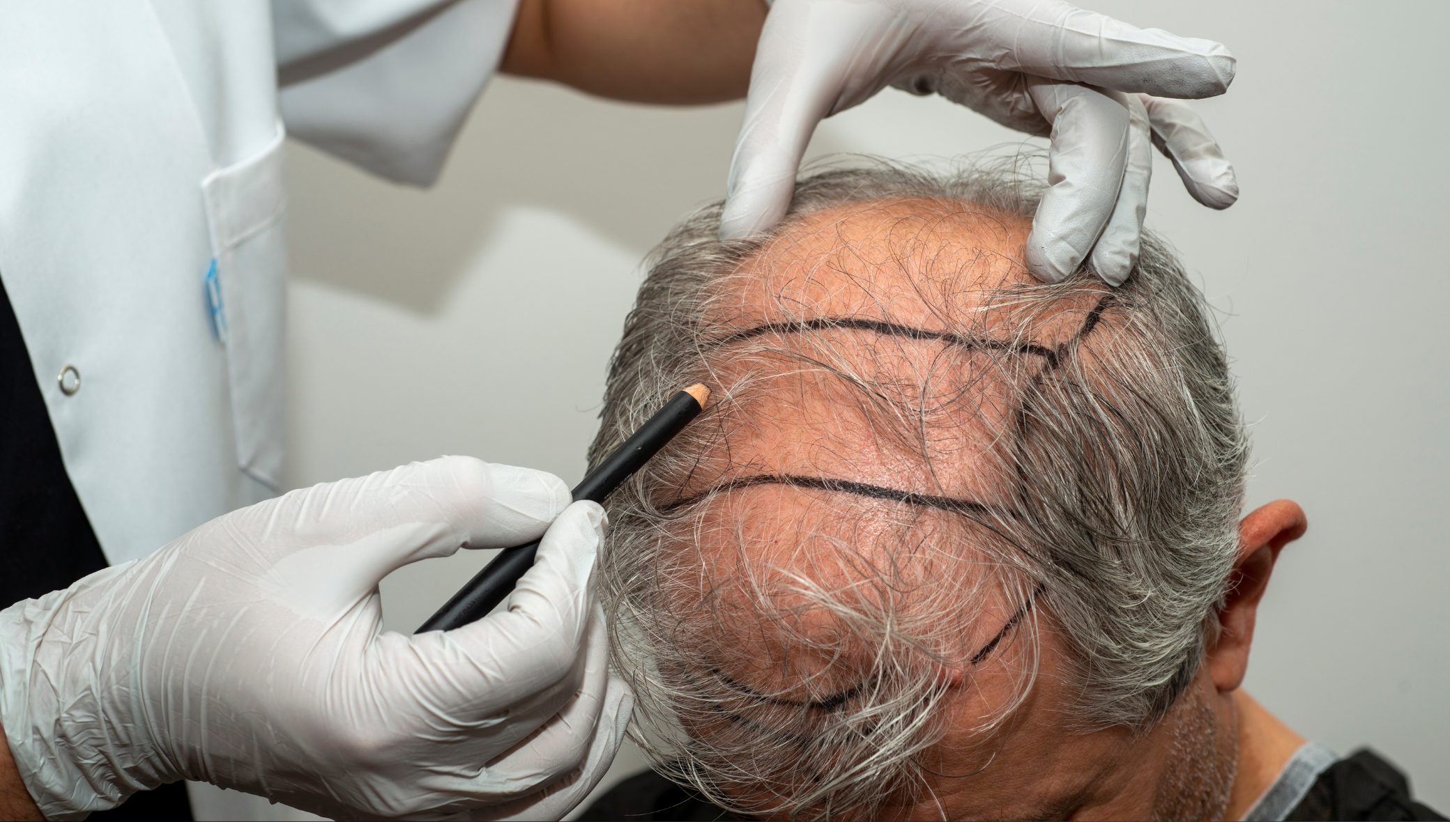 What to Expect During Your First Hair Restoration Consultation in Atlanta