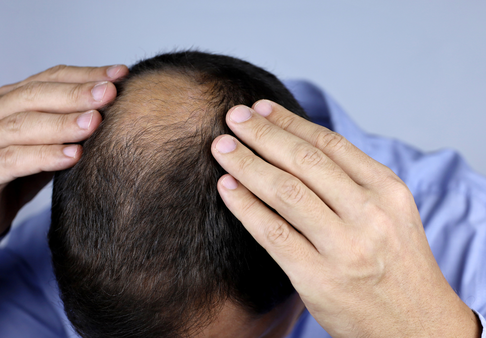 client getting hair loss consultation in atlanta