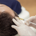 PRP hair treatment Atlanta