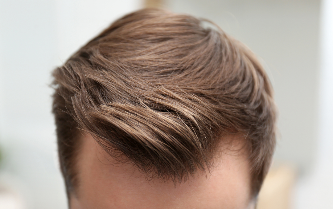 thinning edges hair restoration Atlanta