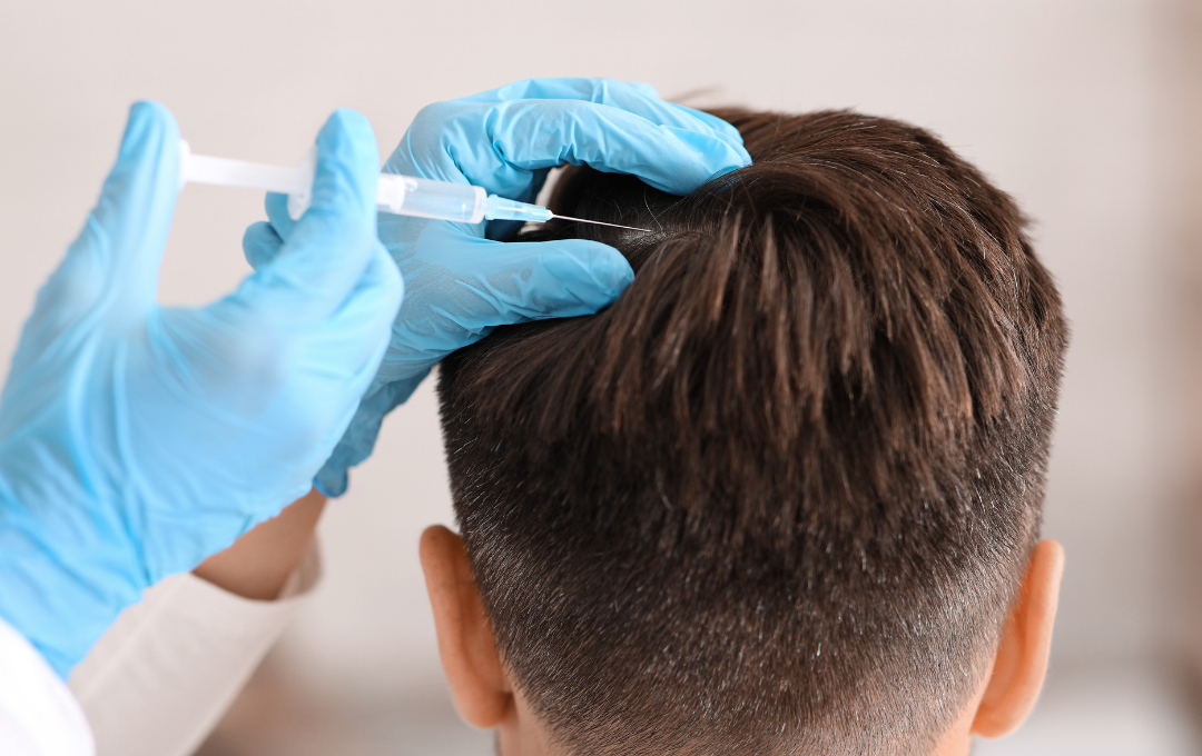 PRP hair treatment for men Atlanta